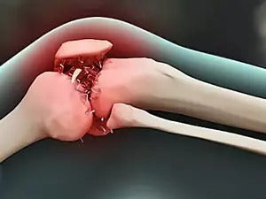 Joelheira FlexiProtec